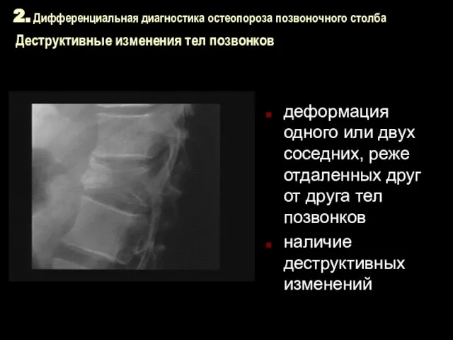 2. Дифференциальная диагностика остеопороза позвоночного столба Деструктивные изменения тел позвонков деформация