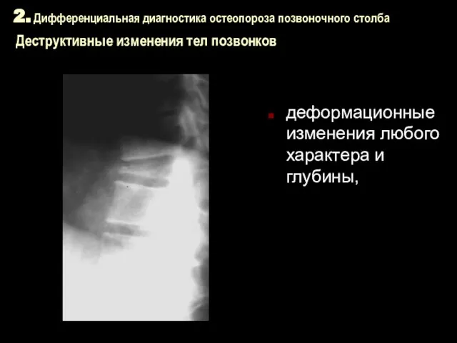 2. Дифференциальная диагностика остеопороза позвоночного столба Деструктивные изменения тел позвонков деформационные изменения любого характера и глубины,