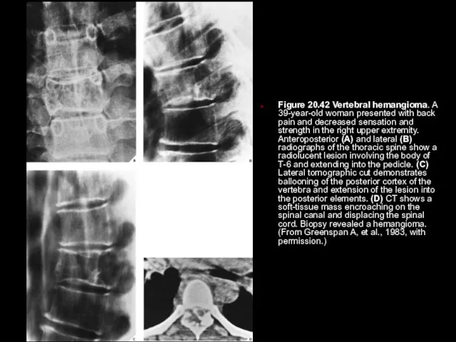 Figure 20.42 Vertebral hemangioma. A 39-year-old woman presented with back pain