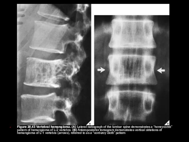 Figure 20.43 Vertebral hemangioma. (A) Lateral radiograph of the lumbar spine