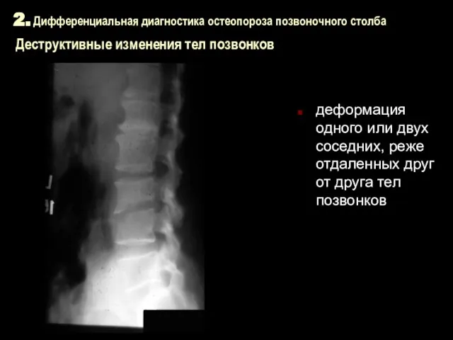 2. Дифференциальная диагностика остеопороза позвоночного столба Деструктивные изменения тел позвонков деформация