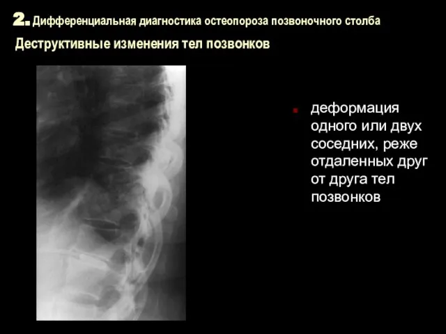 2. Дифференциальная диагностика остеопороза позвоночного столба Деструктивные изменения тел позвонков деформация