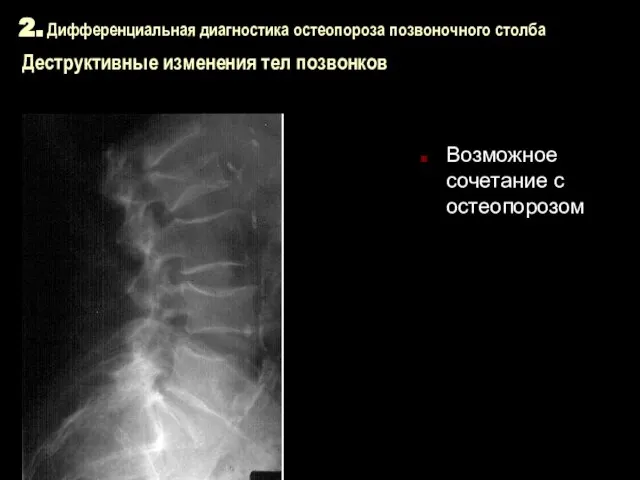 2. Дифференциальная диагностика остеопороза позвоночного столба Деструктивные изменения тел позвонков Возможное сочетание с остеопорозом