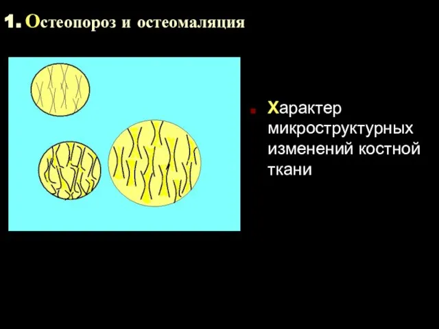 1. Остеопороз и остеомаляция Характер микроструктурных изменений костной ткани