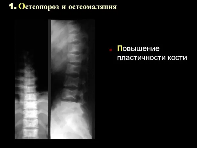 1. Остеопороз и остеомаляция Повышение пластичности кости