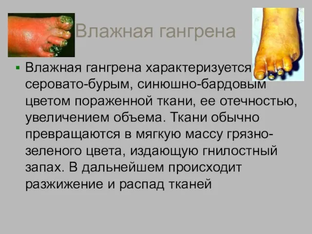 Влажная гангрена Влажная гангрена характеризуется серовато-бурым, синюшно-бардовым цветом пораженной ткани, ее