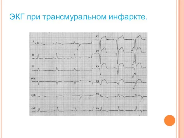 ЭКГ при трансмуральном инфаркте.