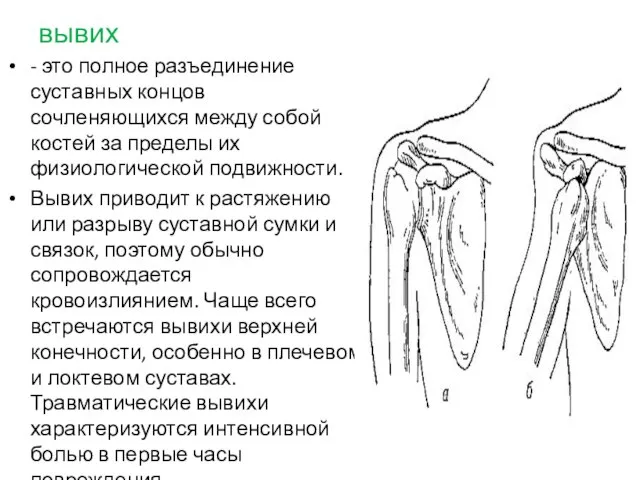 вывих - это полное разъединение суставных концов сочленяющихся между собой костей