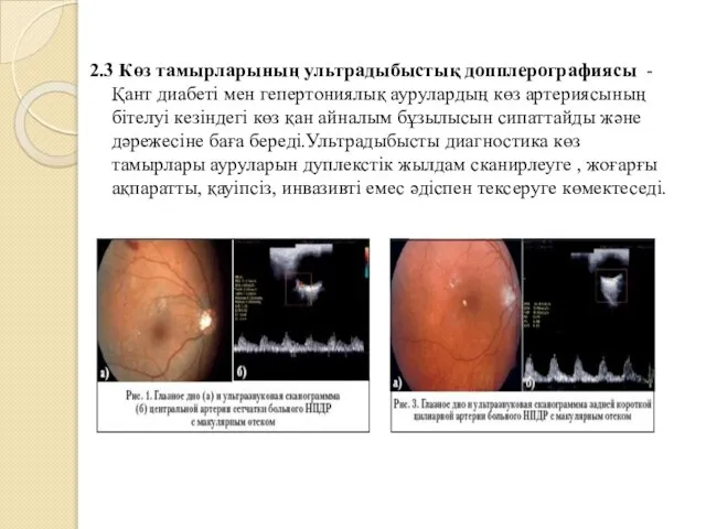 2.3 Көз тамырларының ультрадыбыстық допплерографиясы - Қант диабеті мен гепертониялық аурулардың