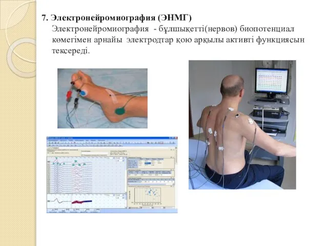 7. Электронейромиография (ЭНМГ) Электронейромиография - бұлшықетті(нервов) биопотенциал көмегімен арнайы электродтар қою арқылы активті функциясын тексереді.