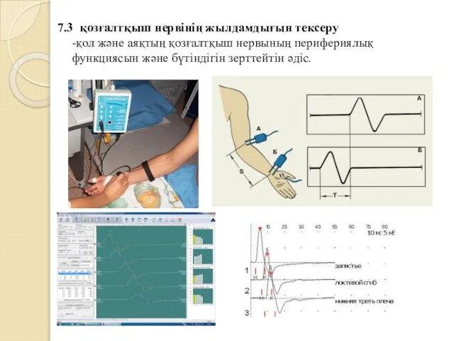 7.3 қозғалтқыш нервінің жылдамдығын тексеру -қол және аяқтың қозғалтқыш нервының перифериялық функциясын және бүтіндігін зерттейтін әдіс.