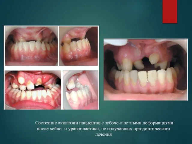 Состояние окклюзии пациентов с зубоче-люстными деформациями после хейло- и уранопластики, не получавших ортодонтического лечения