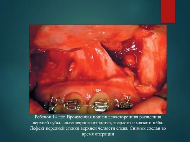 Ребенок 14 лет. Врожденная полная левосторонняя расщелина верхней губы, альвеолярного отростка,