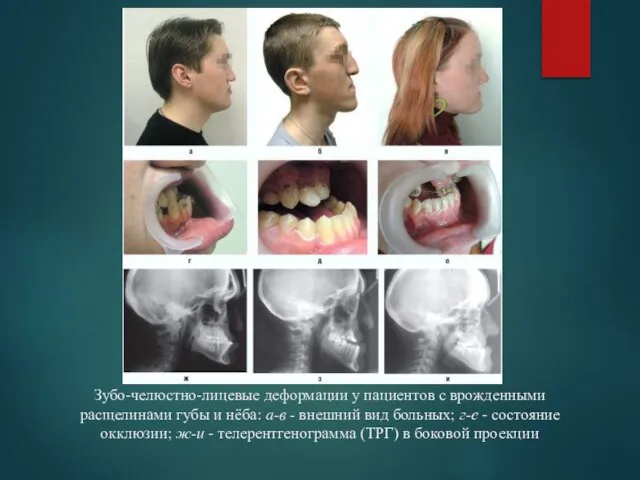 Зубо-челюстно-лицевые деформации у пациентов с врожденными расщелинами губы и нёба: а-в