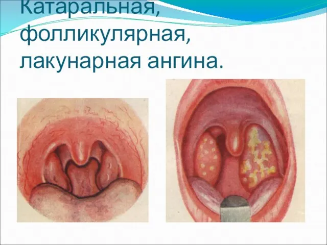 Катаральная, фолликулярная, лакунарная ангина.