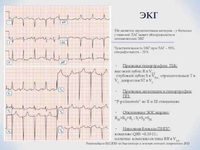 Признаки гипертрофии ПЖ: высокий зубец R в V1-2 , глубокий зубец