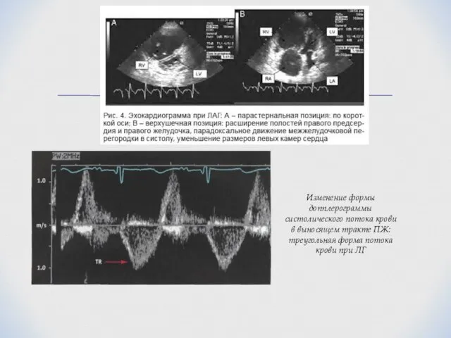 Изменение формы допплерограммы систолического потока крови в выносящем тракте ПЖ: треугольная форма потока крови при ЛГ