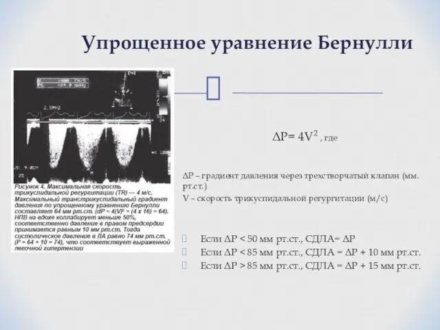 ΔР= 4V2 , где ΔР – градиент давления через трехстворчатый клапан