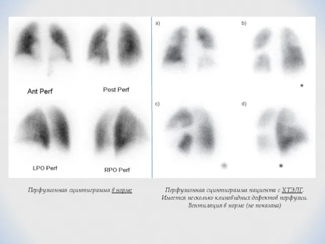 Перфузионная сцинтиграмма пациента с ХТЭЛГ. Имеется несколько клиновидных дефектов перфузии. Вентиляция
