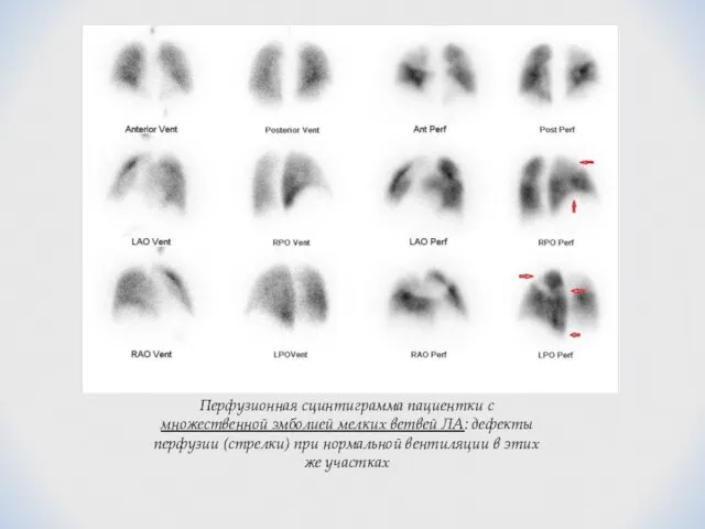 Перфузионная сцинтиграмма пациентки с множественной эмболией мелких ветвей ЛА: дефекты перфузии