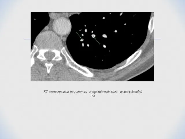 КТ-ангиограмма пациентки с тромбоэмболией мелких ветвей ЛА