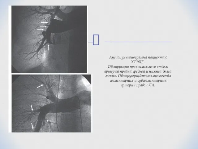 Ангиопульмонограмма пациента с ХТЭЛГ . Обструкция проксимального отдела артерий правых средней