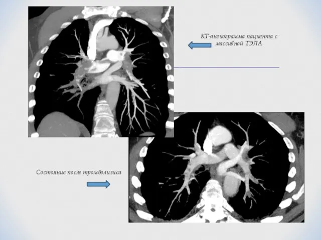 Состояние после тромболизиса КТ-ангиограмма пациента с массивной ТЭЛА