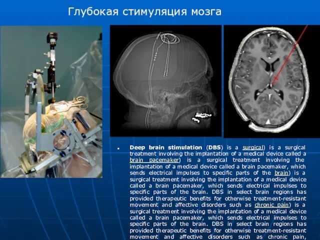 Deep brain stimulation (DBS) is a surgical) is a surgical treatment