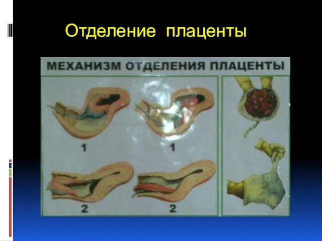 Отделение плаценты