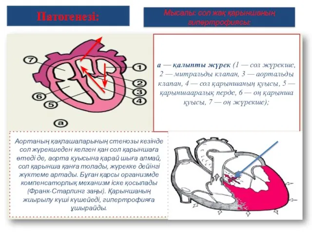 Мысалы: сол жақ қарыншаның гипертрофиясы: Аортаның қақпашаларының стенозы кезінде сол жүрекшеден