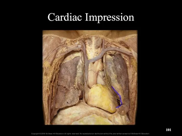 Cardiac Impression