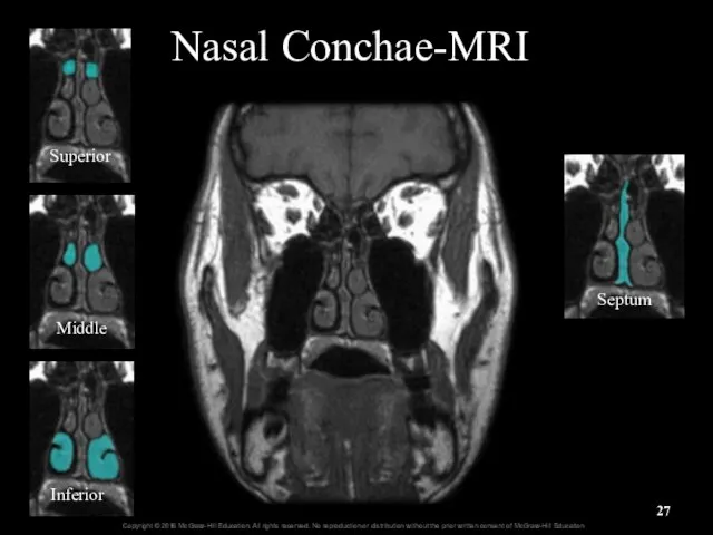 Nasal Conchae-MRI Superior Middle Inferior Septum