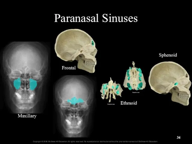 Maxillary Frontal Ethmoid Sphenoid Paranasal Sinuses