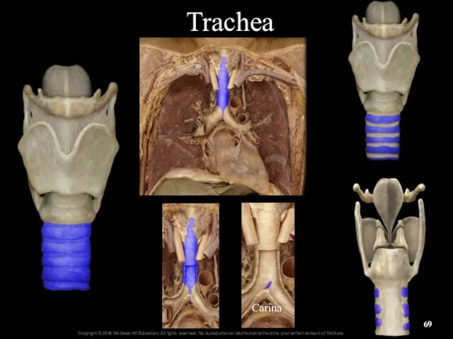 Trachea Carina