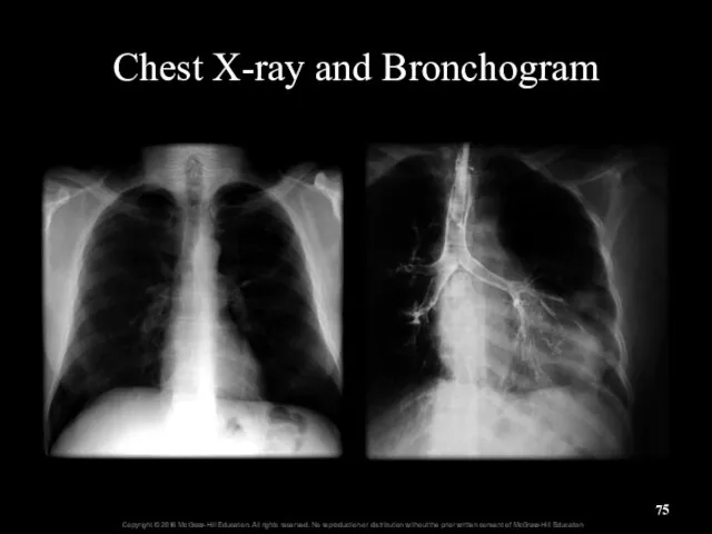 Chest X-ray and Bronchogram