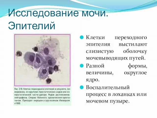 Исследование мочи. Эпителий Клетки переходного эпителия выстилают слизистую оболочку мочевыводящих путей.