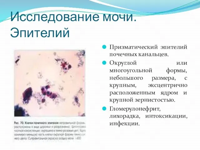 Исследование мочи. Эпителий Призматический эпителий почечных канальцев. Округлой или многоугольной формы,