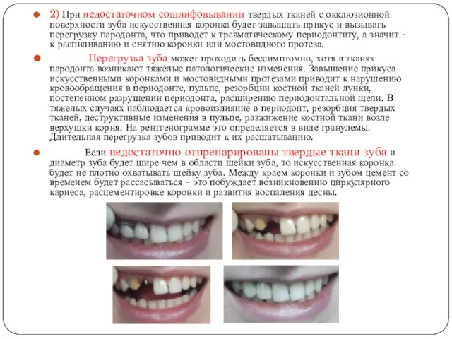 2) При недостаточном сошлифовывании твердых тканей с окклюзионной поверхности зуба искусственная