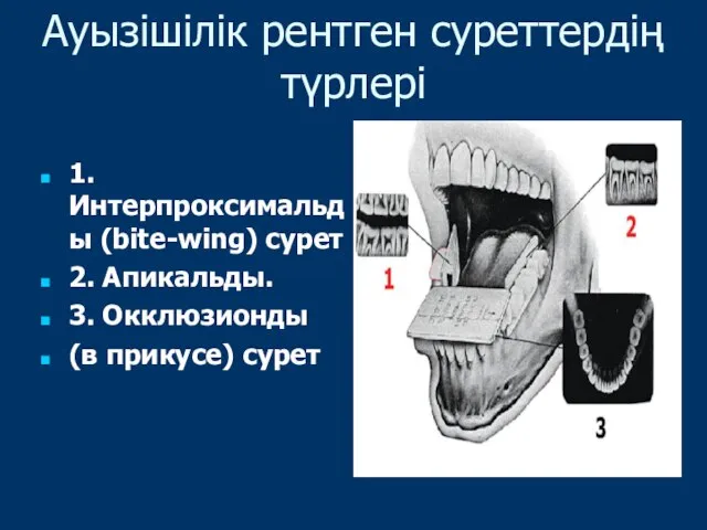 Ауызішілік рентген суреттердің түрлері 1.Интерпроксимальды (bite-wing) сурет 2. Апикальды. 3. Окклюзионды (в прикусе) сурет