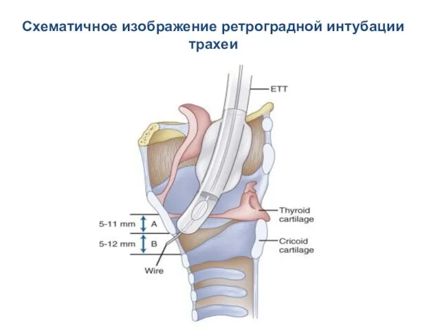 Схематичное изображение ретроградной интубации трахеи