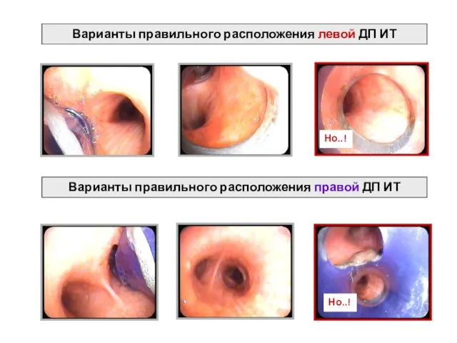 Варианты правильного расположения левой ДП ИТ Варианты правильного расположения правой ДП ИТ Но..! Но..!