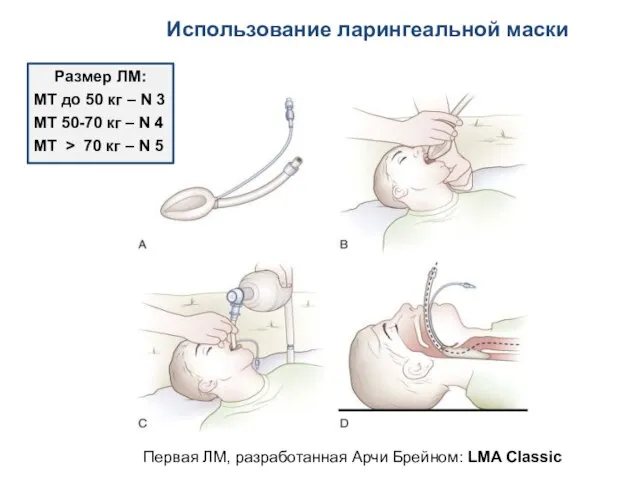 Использование ларингеальной маски Размер ЛМ: МТ до 50 кг – N