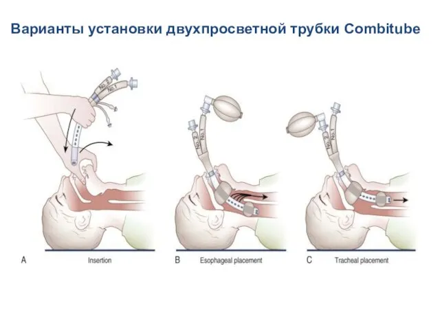 Варианты установки двухпросветной трубки Combitube