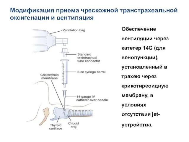 Обеспечение вентиляции через катетер 14G (для венопункции), установленный в трахею через