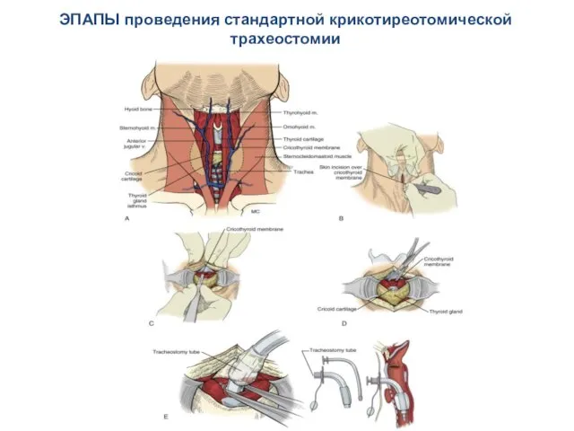 ЭПАПЫ проведения стандартной крикотиреотомической трахеостомии