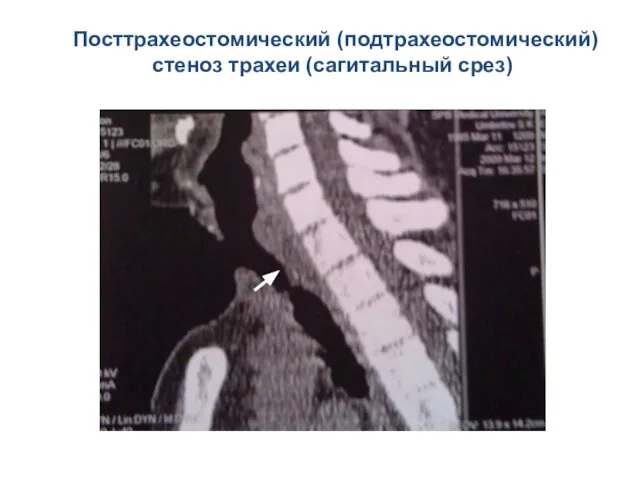 Посттрахеостомический (подтрахеостомический) стеноз трахеи (сагитальный срез)