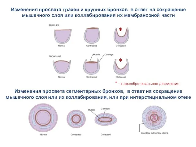 Изменения просвета сегментарных бронхов, в ответ на сокращение мышечного слоя или