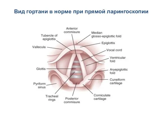 Вид гортани в норме при прямой ларингоскопии