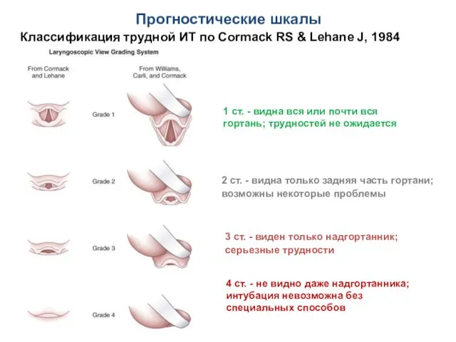 Прогностические шкалы Классификация трудной ИТ по Cormack RS & Lehane J,