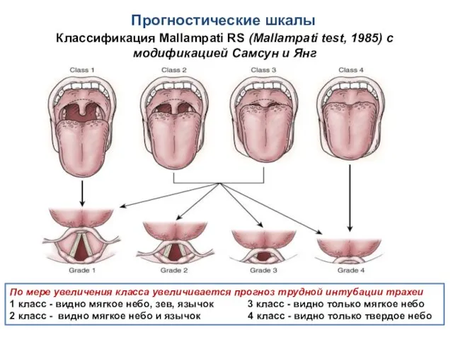 Прогностические шкалы Классификация Mallampati RS (Mallampati test, 1985) с модификацией Самсун